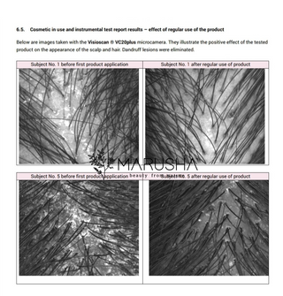 dandruff lesions treatment before and after images of two subjects